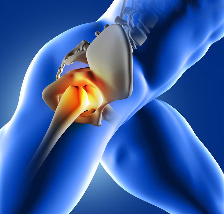 Hip Replacement